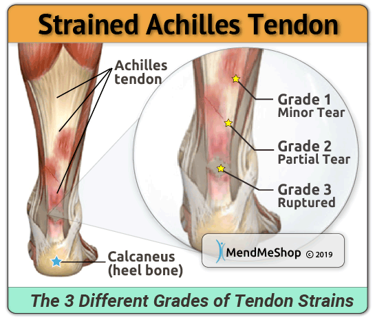 tendon strain classification achilles