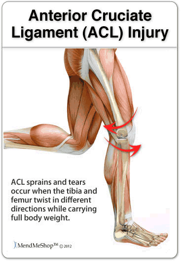 Acute ACL injuries can be caused by a sudden twist or pivot in movement.