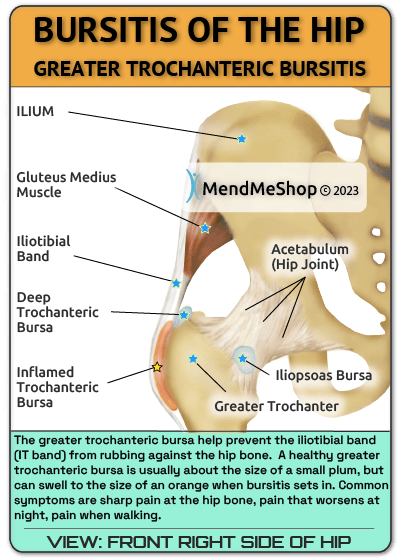 hip bursitis, greater trochanteric bursitis