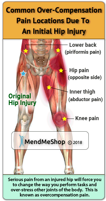 Over compensation pain can result in a severe setback when recovering from a Hip injury.