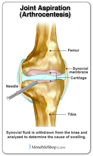 arthrocentesis knee