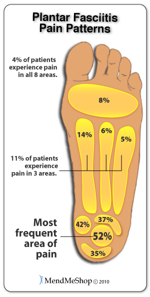 plantar fasciitis pain locations