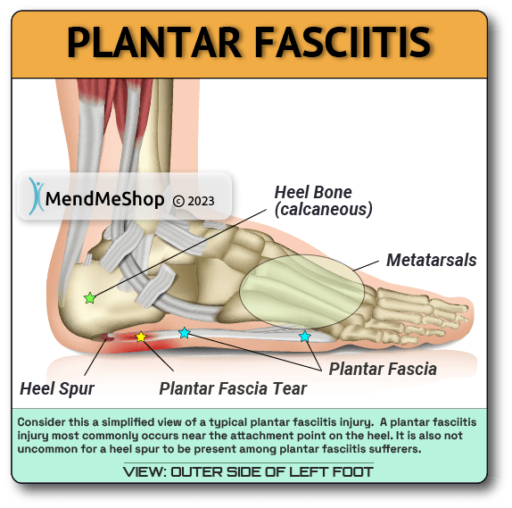 plantar fasciitis most common area of injury is at the heel