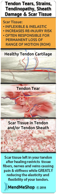 Hamstring muscle tears heal with scar tissue.