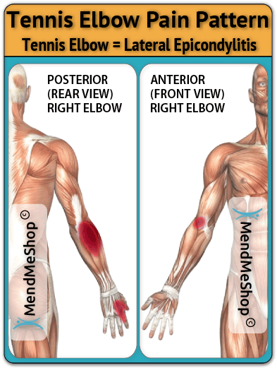 Tennis Elbow, Wrist, Forearm pain pattern