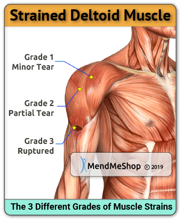 3 types of muscle strain deltiod