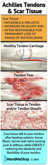 Scar tissue on Achilles tendon