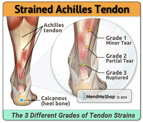 grades of achilles tendonitis