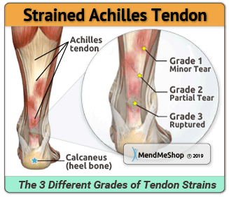 Types of Achilles Strain