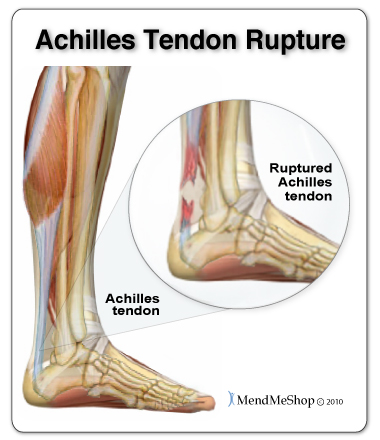 Major Achilles tendon tears cause severe instability in the lower leg & require surgery