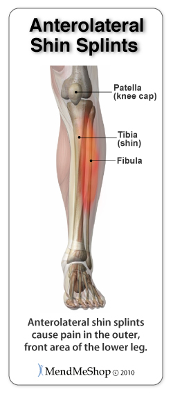 Anterolateral Shin Splint pain occurs in the outer from