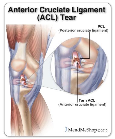 torn acl