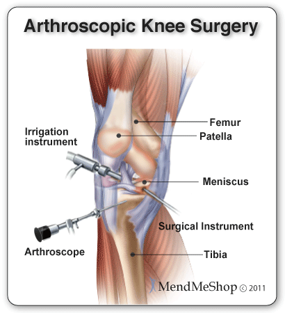 knee arthroscopy surgery tendons