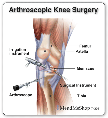 arthroscopic knee surgery