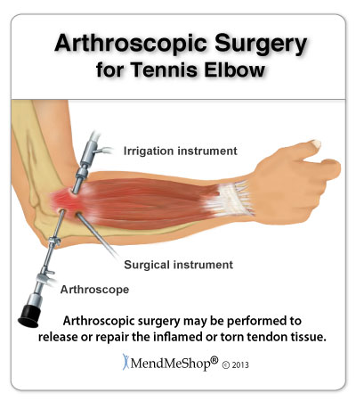 Tennis Elbow Diagnosis Test
