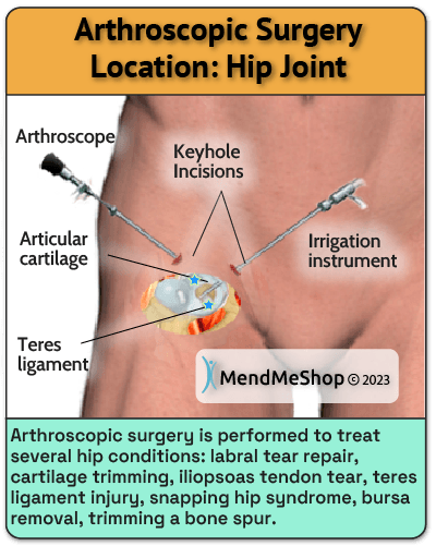 visual illustration hip joint arthroscopic surgery