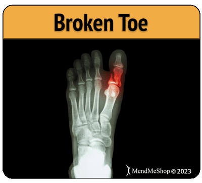 broken bone big toe x-ray