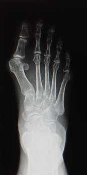an x-ray of a foot with a bunion