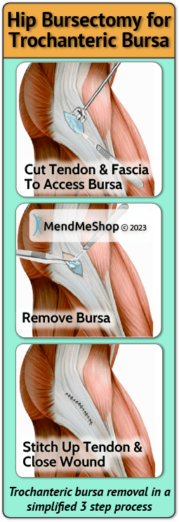 trochanteric hip bursa bursectomy removal steps