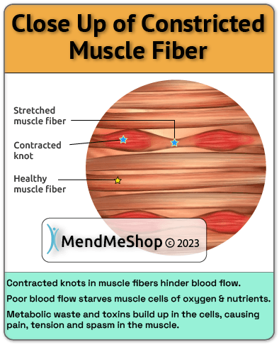 constricted muscle fiber & muscle spasms
