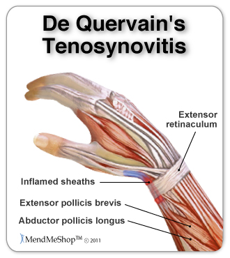 De Quervain's Syndrome