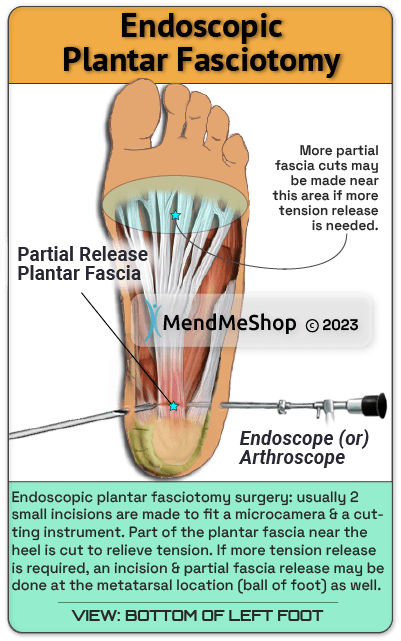 visual illustration plantar fasciotomy arthroscopic surgery