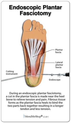 Endoscopic plantar fasciotomy