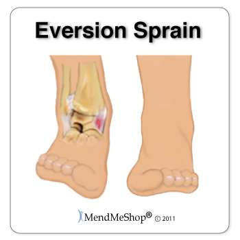 Sprained ankle - eversion sprain