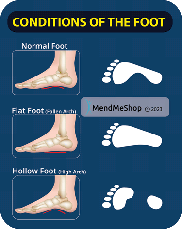 foot arch infographic