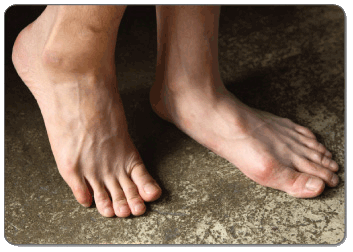 Conservative treatments are best way to treat foot bursitis of any kind