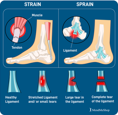 foot strain vs foot sprain