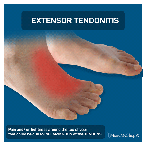 Extensor Tendonitis top of foot