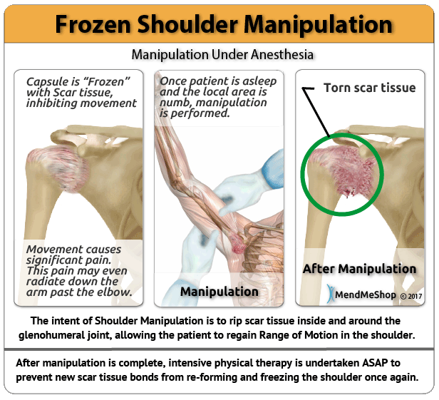 How to Sleep with a Frozen Shoulder