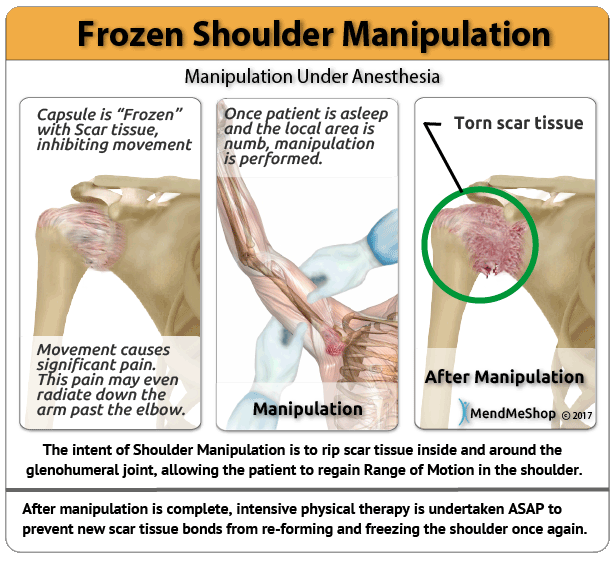 shoulder-manipulation-overview