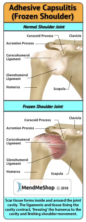 Adhesive capsulitis-a build up of scar tissue in shoulder joint rotator cuff causing shoulder to be immobile or frozen.