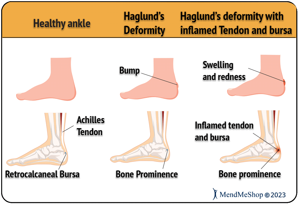 Haglund's deformity hot sale home remedies