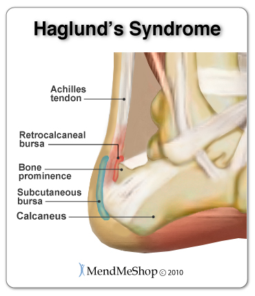 Haglund's Deformity Exercises: Relieve Pain & Swelling | Liebscher & Bracht