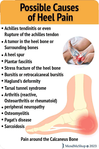 Considering An Autoimmune Etiology In The Differential Diagnosis Of Heel  Pain