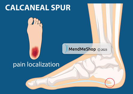 Heel spur: definition of this talalgia