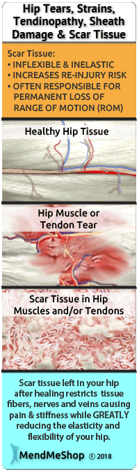 Scar tissue develops as damaged soft tissue heals