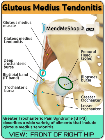tendonitis of the gluteus medius