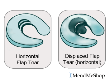 A horizontal meniscus tear displaced flap