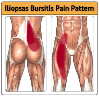 iliopsoas bursitis hip bursa pain pattern