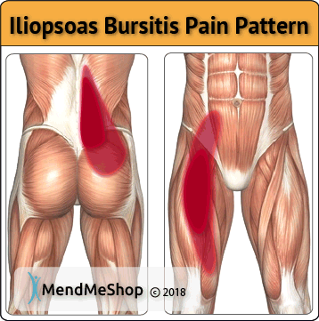 Iliopsoas bursitis pain patterns