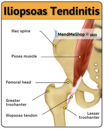 Iliopsoas bursitis is often found in conjunction with iliopsoas tendinitis