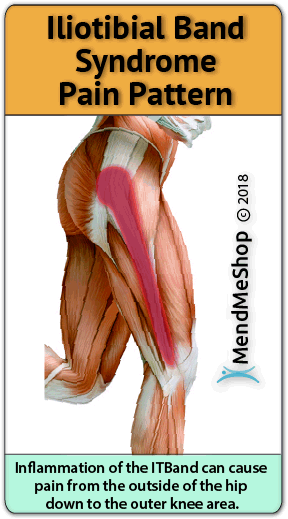 iliotibial band syndrome pain-pattern hip