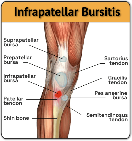 Infrapatellar bursitis location in knee