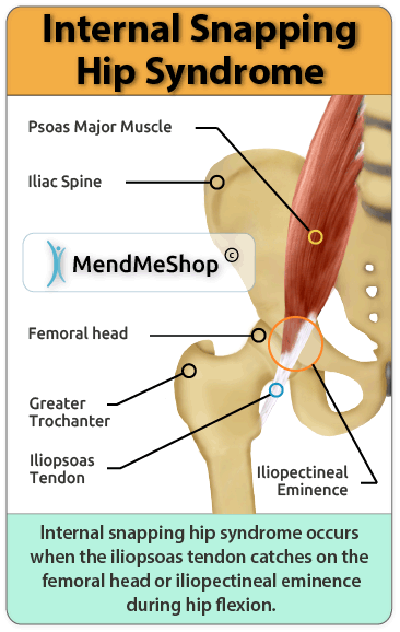 Snapping hip syndrome