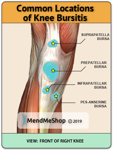 common areas for knee bursitis