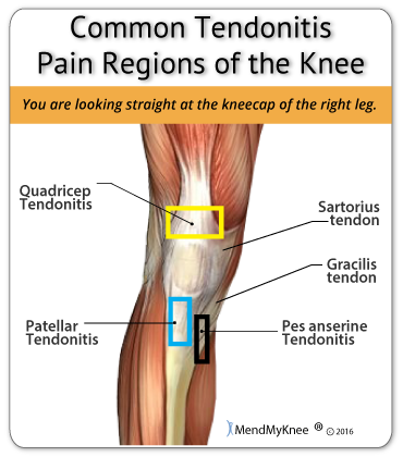 tendonitis name & location in the knee